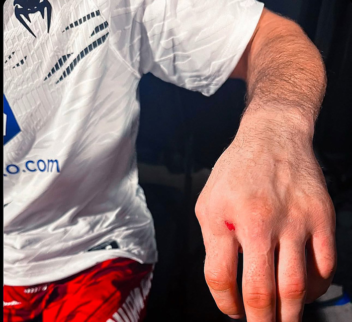 umar nurmagomedov broken hand