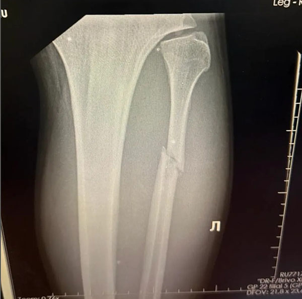 valter walker spasmeno kokkalo